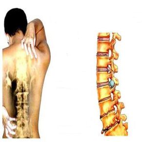 Faze osteohondroze