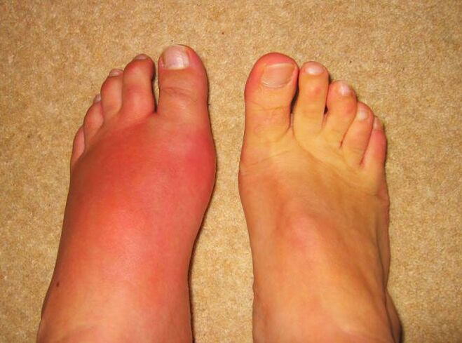 bol u zglobovima nogu zbog gihta